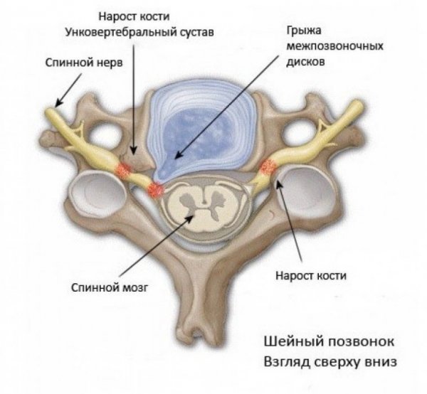 Унковертебральний артроз шийного відділу хребта: що це таке, лікування
