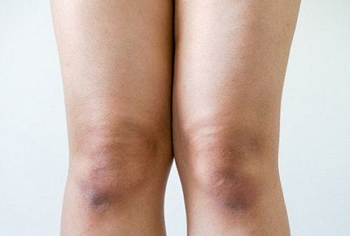 Груба шкіра на ліктях і колінах: чому лущиться шкіра на ліктях, як пом'якшити шкіру