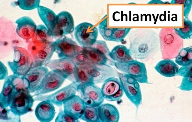 Діагностика хламідіозу: аналізи на chlamydia trachomatis, розшифровка у чоловіків і жінок