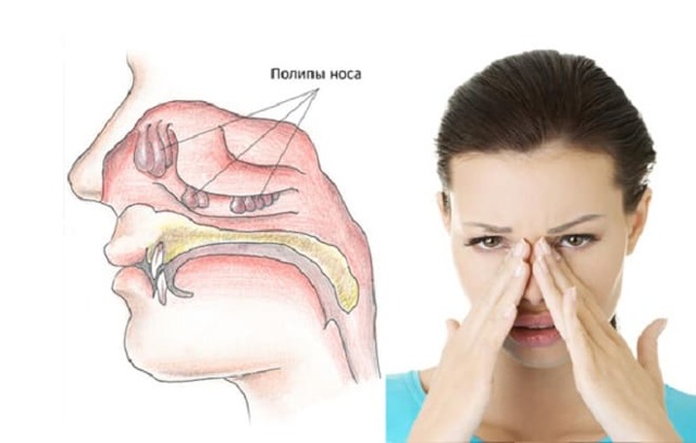 Поліпи в носі: як виглядають, симптоми і лікування у дорослих