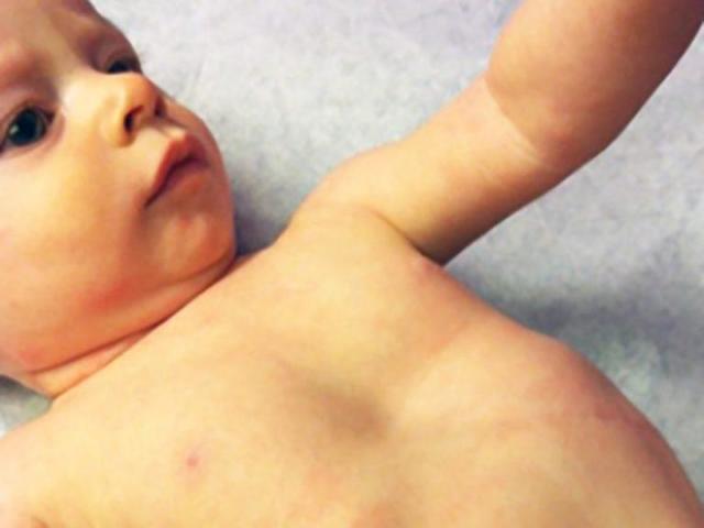 Воронкоподібна грудна клітка у дитини: фото, лікування без операції, операція