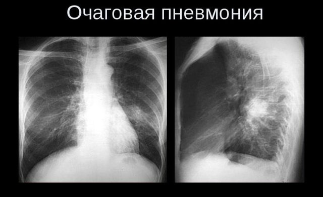 Ознаки пневмонії на флюорографії