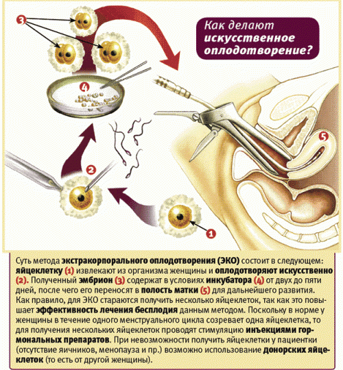 ІКСІ-запліднення: що це таке, основні відмінності репродуктивних технологій, свідчення і етапи проведення