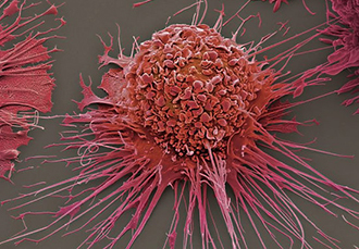 Плоскоклітинний рак гортані: причини, симптоми і лікування