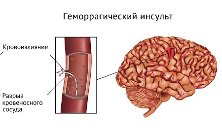 Геморагічний інсульт головного мозку: лікування, наслідки та прогнози
