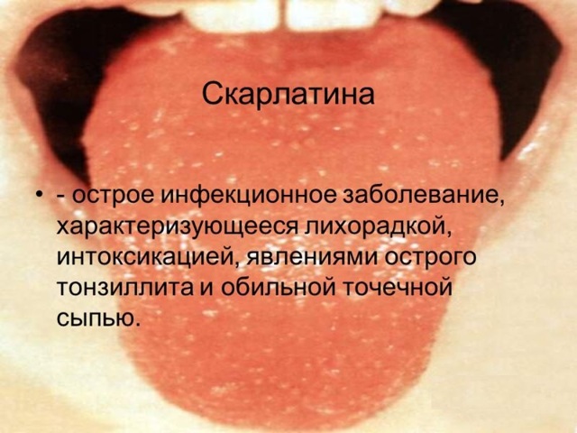 Висип і головний біль у дорослого і дитини без ознак застуди і температури