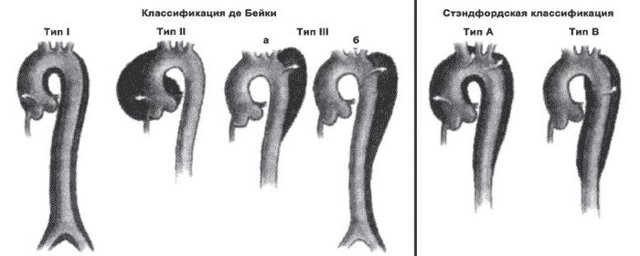 Аортит: що це таке, причини, симптоми, лікування, профілактика