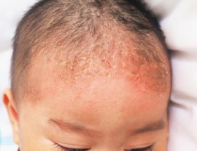 Себорейний дерматит - лікування особи, волосистої частини голови і тулуба
