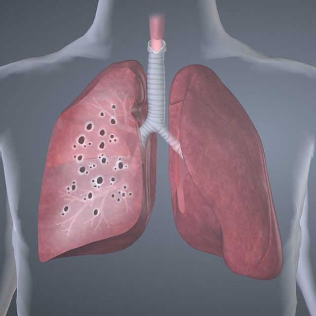 Саркоїдоз легенів: симптоми, лікування, причини та прогноз
