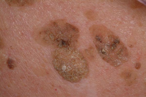 Актініческій кератоз шкіри: що це таке, симптоми, лікування сонячного кератозу