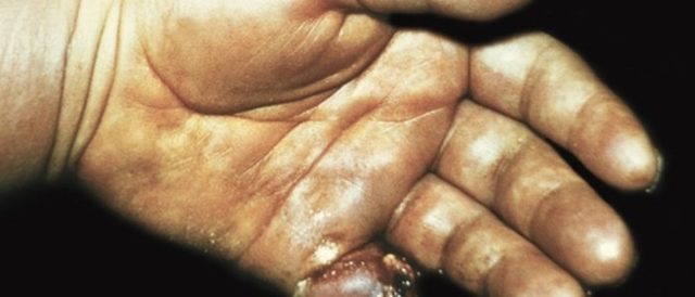 Панариций на пальці руки, ноги, форми панарицію, симптоми і лікування панарицію 