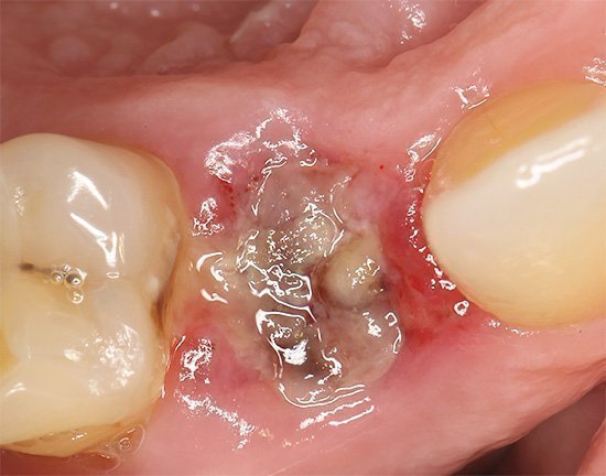 Лікування після видалення зуба: чим полоскати для швидкого загоєння