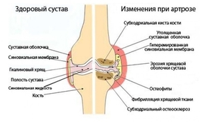 Розсікаючий остеохондрит тазостегнового суглоба: симптоми, лікування