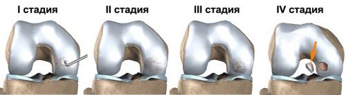 Розсікаючий остеохондрит тазостегнового суглоба: симптоми, лікування