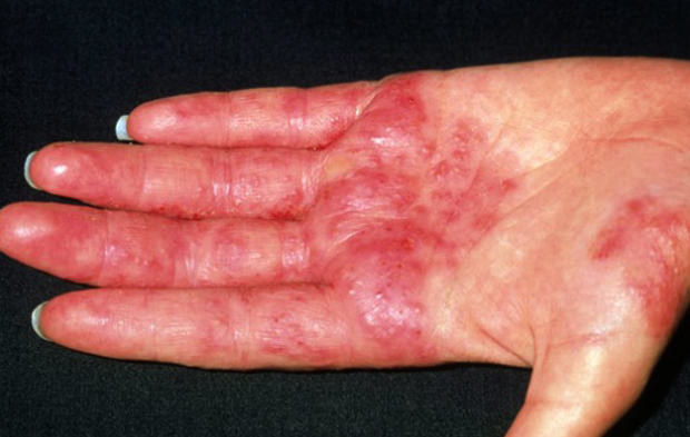 Алергія на метал: залізо, цинк, нікель. Симптоми і лікування