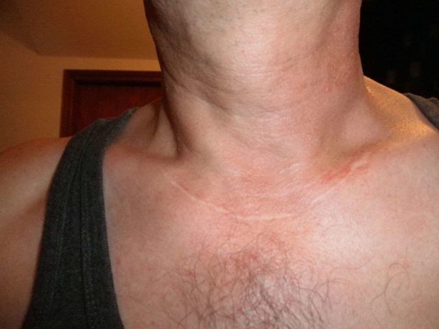 Щитовидка у чоловіків: симптоми проблем, ознаки та лікування