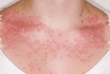 Алергічний контактний дерматит симптоми і лікування у дорослих