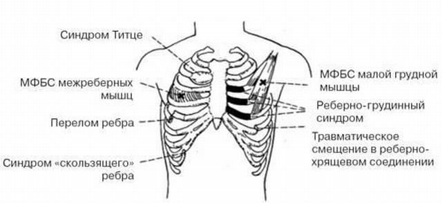 Перихондрит ребер справа і зліва: симптоми і лікування