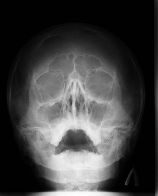 Рентген носа: як часто можна робити, що показує і правила проведення