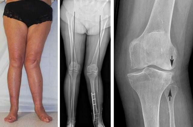 Вальгусна деформація колінних суглобів у дорослих і дітей: причини, лікування