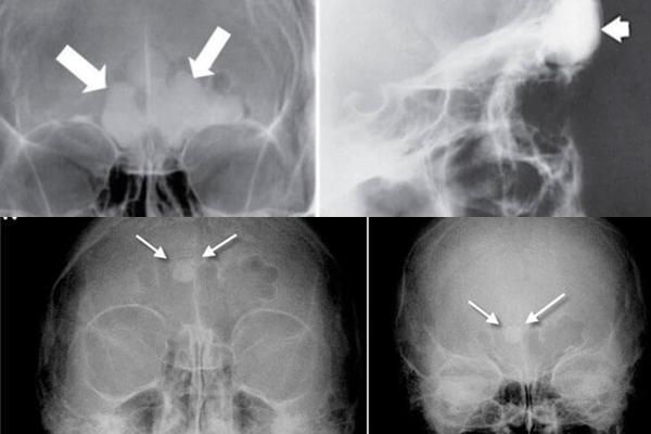 Фронтит на рентгенівському знімку і МРТ: коли необхідний, що показує?
