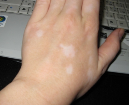 Від чого з'являються білі плями на руках