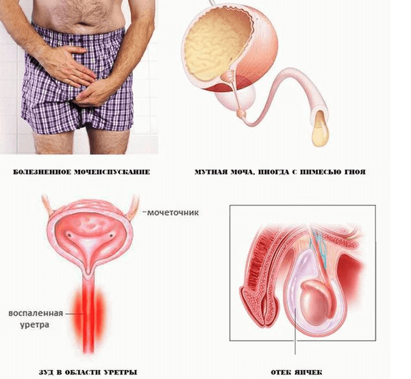 Трихомонадний уретрит у чоловіків і жінок: симптоми, лікування