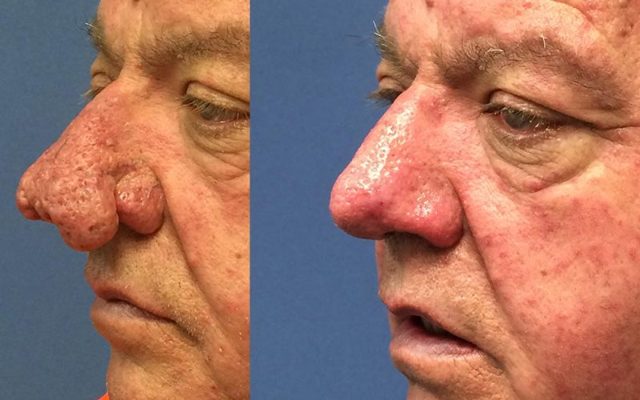 Рінофіма носа: симптоми, причини і методи лікування