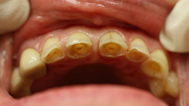 Підвищена стираемость зубів: що робити, якщо стирається емаль зубів