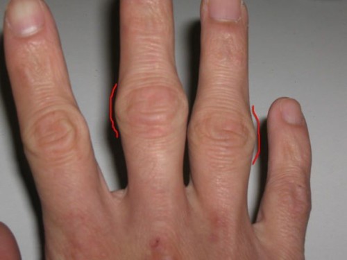 Запалення суглобів пальців рук і ніг: основні причини, типові симптоми, методи терапії і профілактика