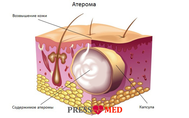 Атерома - лікування, видалення атероми, видалення атероми лазером, ризики після видалення атероми