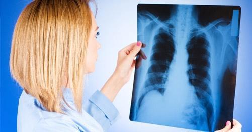 Фіброз легенів: що це таке і як лікувати, симптоми фіброзу легенів і лікування