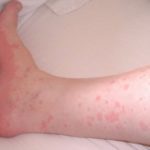 Контактна алергія: причини, симптоми, діагностика, лікування та профілактика