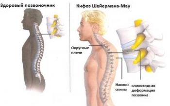 Кіфоз у дітей: як проявляється, що викликає, діагностика