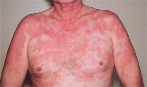 Туберкульоз шкіри - симптоми початкової стадії, причини, лікування дорослих і дітей