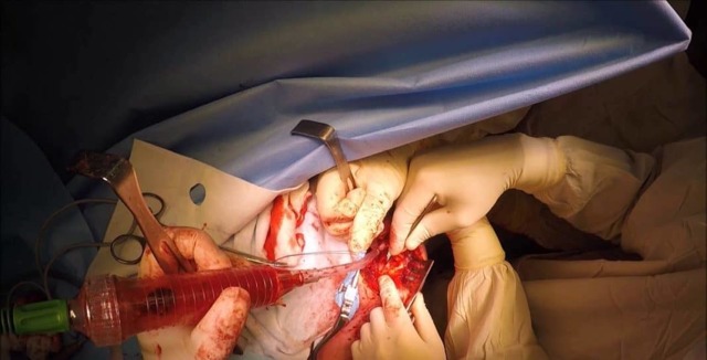 Відкритий перелом плечової кістки зі зміщенням та без: перша допомога, ознаки