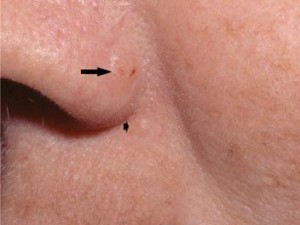 Освіти на шкірі носа: причини, види, лікування та профілактика