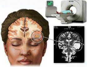 Комп'ютерна томографія головного мозку: визначення, показання та протипоказання, різновиди.