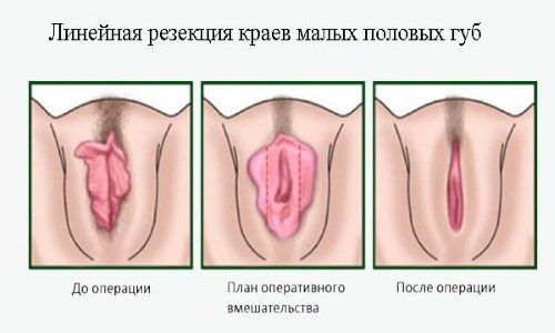 Великі статеві губи менше малих: Лабіопластика для зменшення малих статевих губ