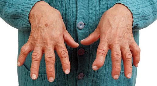 Ревматоїдний артрит: симптоми, лікування, діагностика, народне лікування ревматоїдного артриту