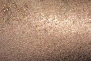 Вульгарний іхтіоз шкіри: симптоми, фото у дітей, успадкування та лікування