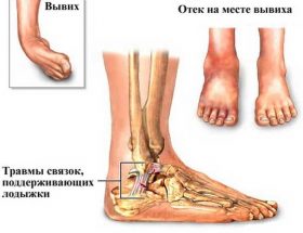 Вивих ноги в районі щиколотки: види пошкоджень, характерні симптоми, методика лікування і період реабілітації