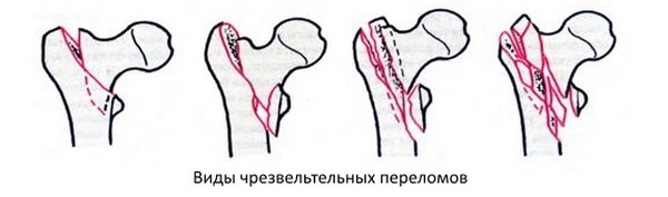 Відкритий перелом стегнової кістки зі зміщенням та без: невідкладна допомога, особливості лікування, терміни відновлення