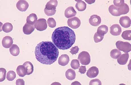 Чому підвищені моноцити в крові: причини їх високий вміст