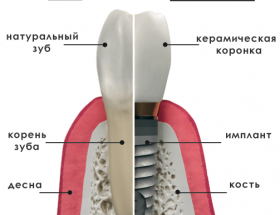 Зубні імплантати: переваги і недоліки, показання та протипоказання до установки