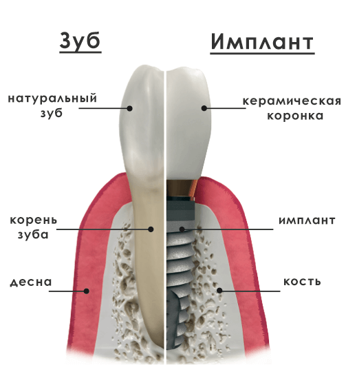 Зубні імплантати: переваги і недоліки, показання та протипоказання до установки