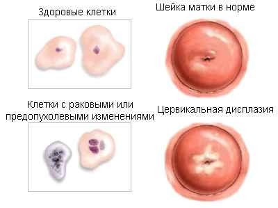 Цитологічний аналіз шийки матки