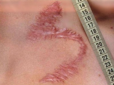 Лікування рубців, як прибрати рубці на шкірі, видалення рубців і шрамів