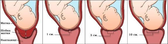 Коротка шийка матки при вагітності: що робити?
