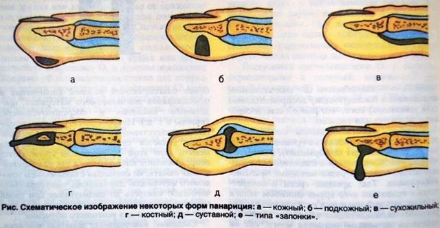 Кістковий панарицій великого пальця кисті: причини виникнення, симптоми і методи лікування з докладними фото